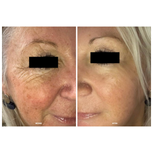 Calecim Professional Serum 5ml (2 gb)