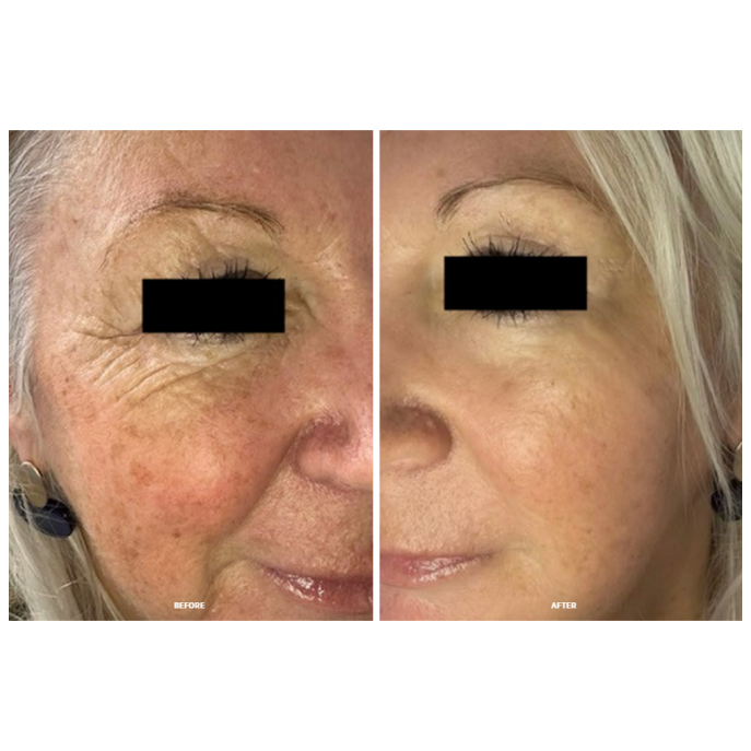 Calecim Professional Serum 5ml (2 gb)