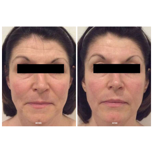 Calecim Professional Serum 5ml (2 gb)