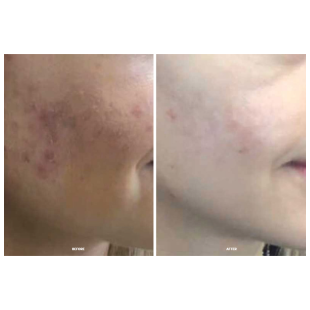 Calecim Professional Serum 5ml (2 gb)