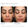 PCA Skin Acne Control Prebiotic Gel Cleanser 207ml